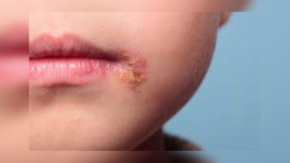 تفاوت آفت و تبخال در کودکان؛ از علت تا راه‌های پیشگیری و درمان